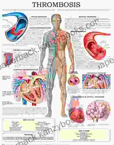 Thrombosis E Chart: Quick Reference Guide