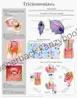 Trichomoniasis E Chart: Full Illustrated